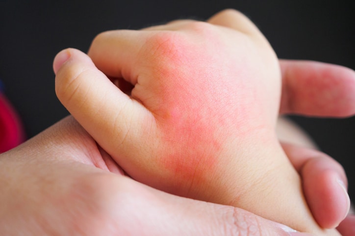 3 Most Common Allergic Reactions in Kids