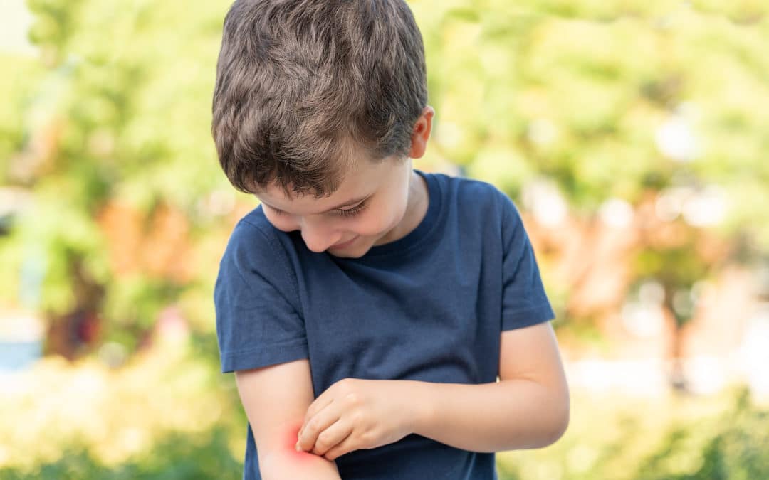 Treating Bee Stings and Bug Bites in Kids