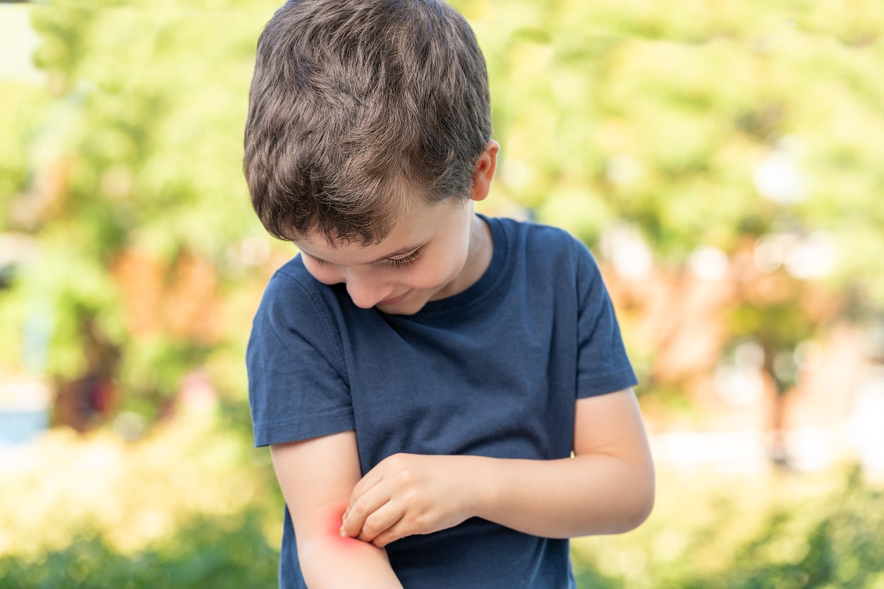 little boy scratching bug bites in kids