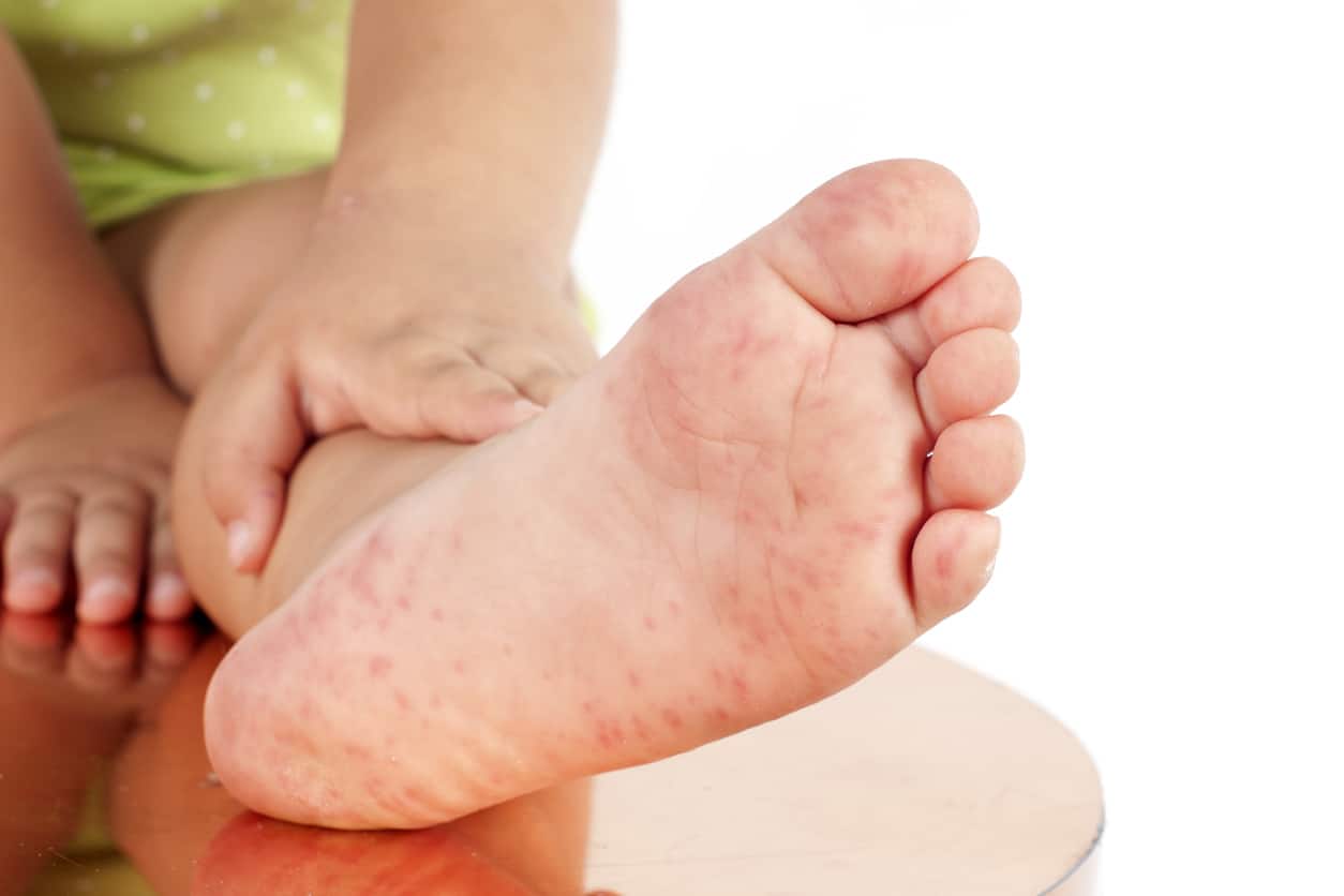 skin rash vs. poison ivy in kids on little girls foot