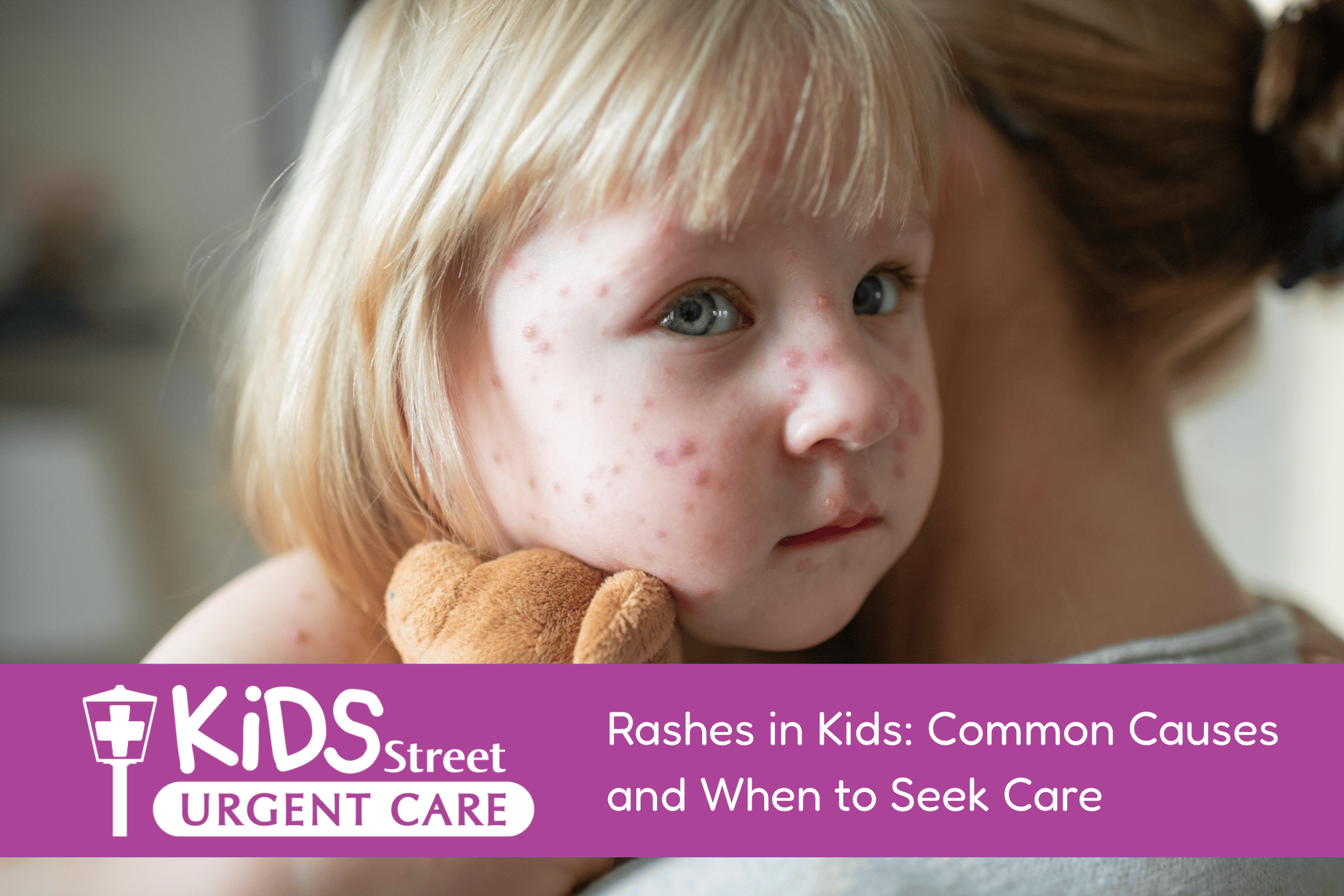 Rashes in Kids Common Causes and When to Seek Care Little girl with a rash on her face. Featured image for Rashes in Kids: Common Causes and When to Seek Care blog post.